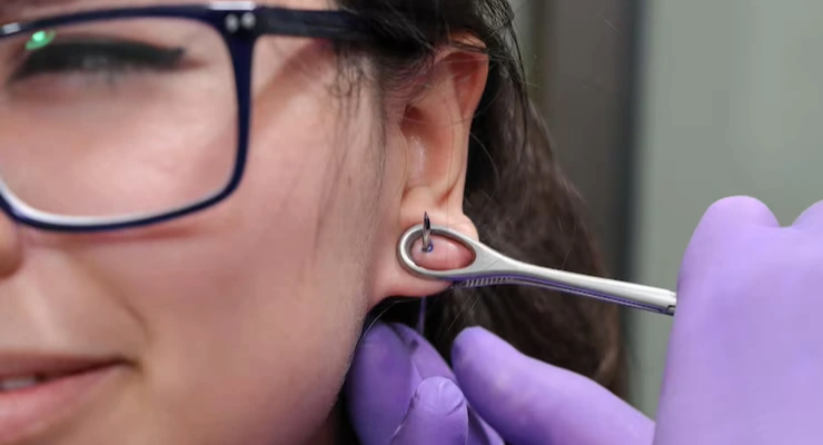 Ear Lobe Repair Surgery